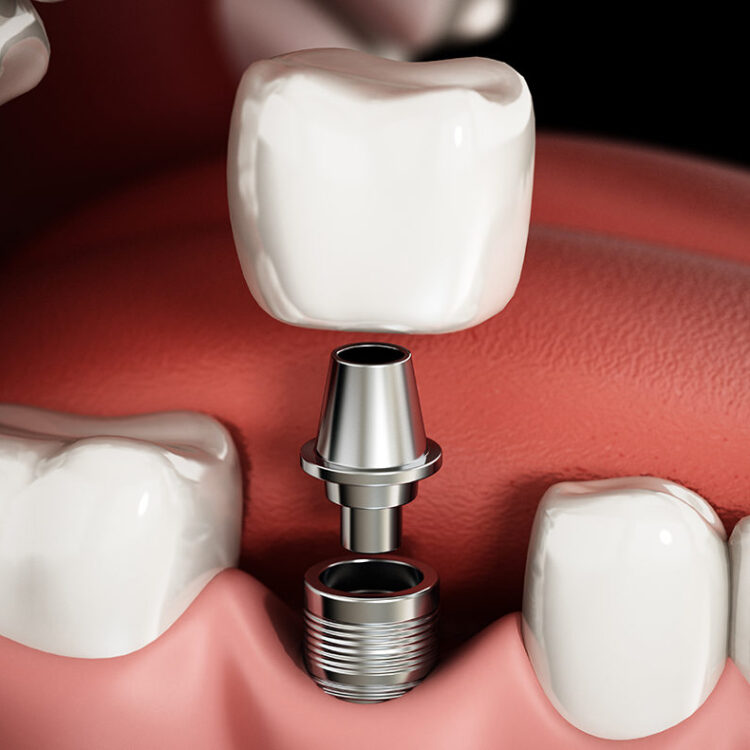 Renew Family Dental's Modern Dental Implants