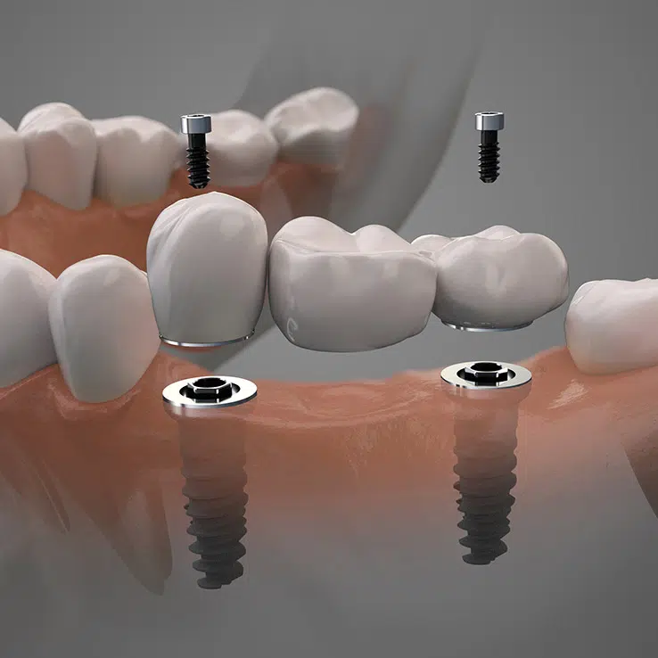 A 3D rendering of teeth implants from Renew Family Dental.