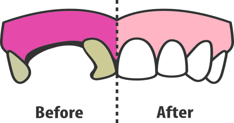 Before and after implants