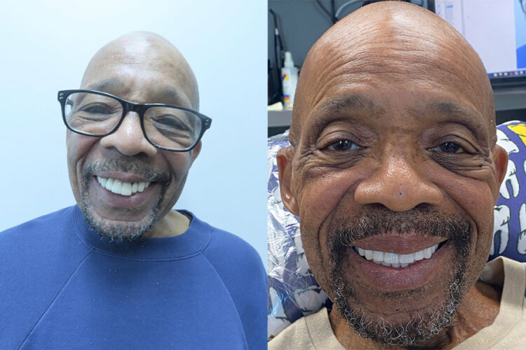 Complete mouth restoration South Florida