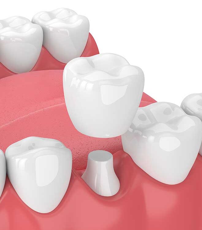 Dental Crown for Healthy Root