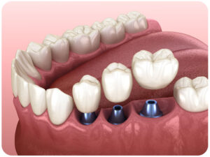 dental implants