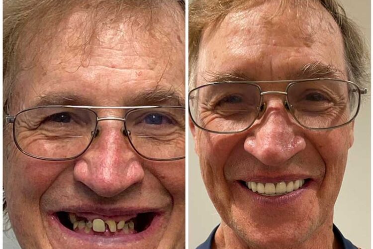 Before and after Renew Family Dental patient