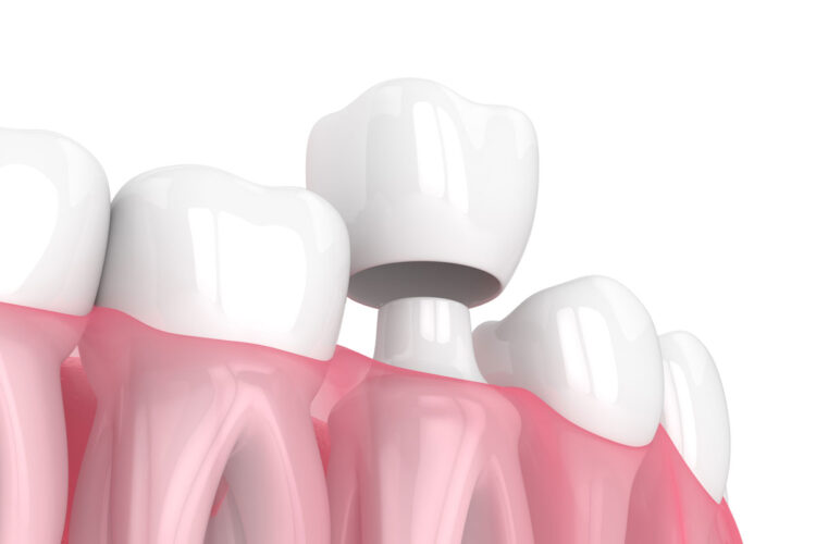 Dental Crowns North Lauderdale